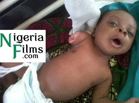 E-x-c-l-u-s-i-v-e Pictures: A Three Week-Old Boy’s Arm Amputated, Mother Cries for Help