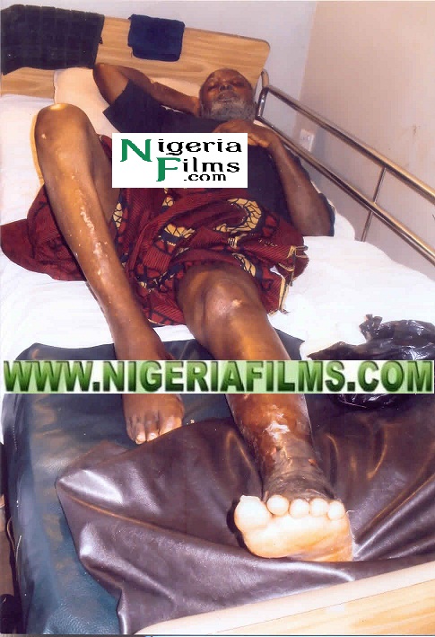 Exclusive Pictures Of Veteran Actor, Pete Eneh’s Infected Leg Before Amputation [Viewers Discretion Advised]