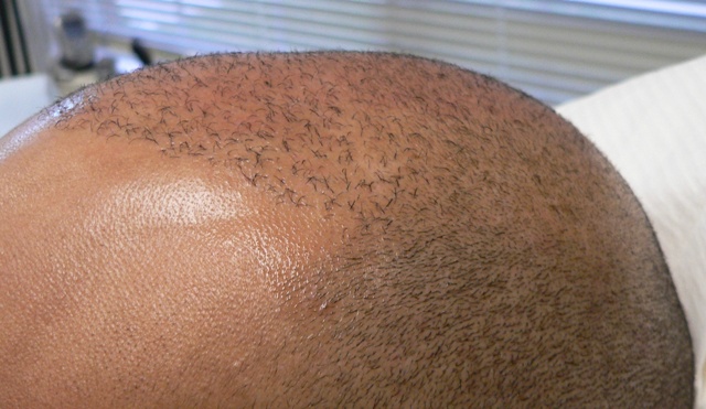 Hair Loss During Chemotherapy