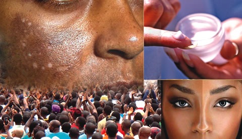 Nigerians, Top Users Of Bleaching Creams — WHO ( World Health Organisation)