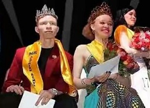 Albinism Pageant