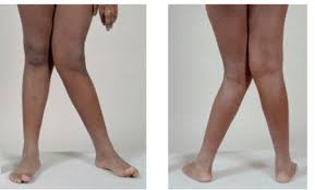 Alibaba Advises Ladies with “K LEG” to Desist From Mini skirt