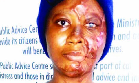 Wicked World: Lagos Lady Cries Out for Justice as Jealous Ex-lover Baths Her with Acid (Photos)