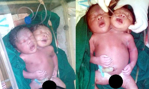 Strange: Woman Gives Birth to Baby with Two Heads