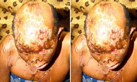 Dumped Lover bathes Ex-Girlfriend with Acid (Graphic )