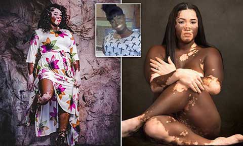 Winnie Harlow Now Inspiring People Living With Vitiligo