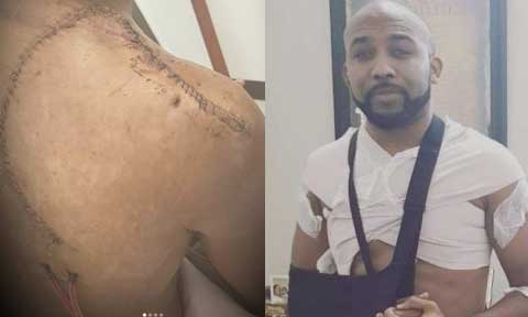 Banky W undergoes successful skin cancer operation (photos)