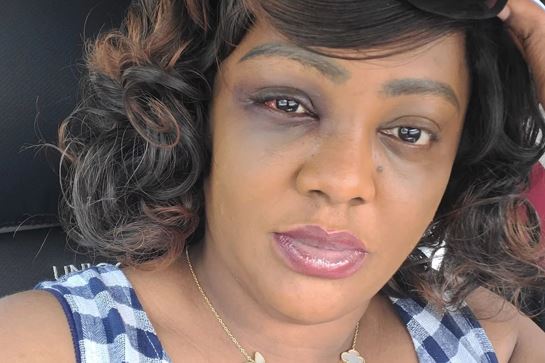 Why I Have Bruised Face – Comedian Helen Paul